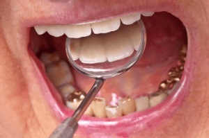dentist inspecting teeth